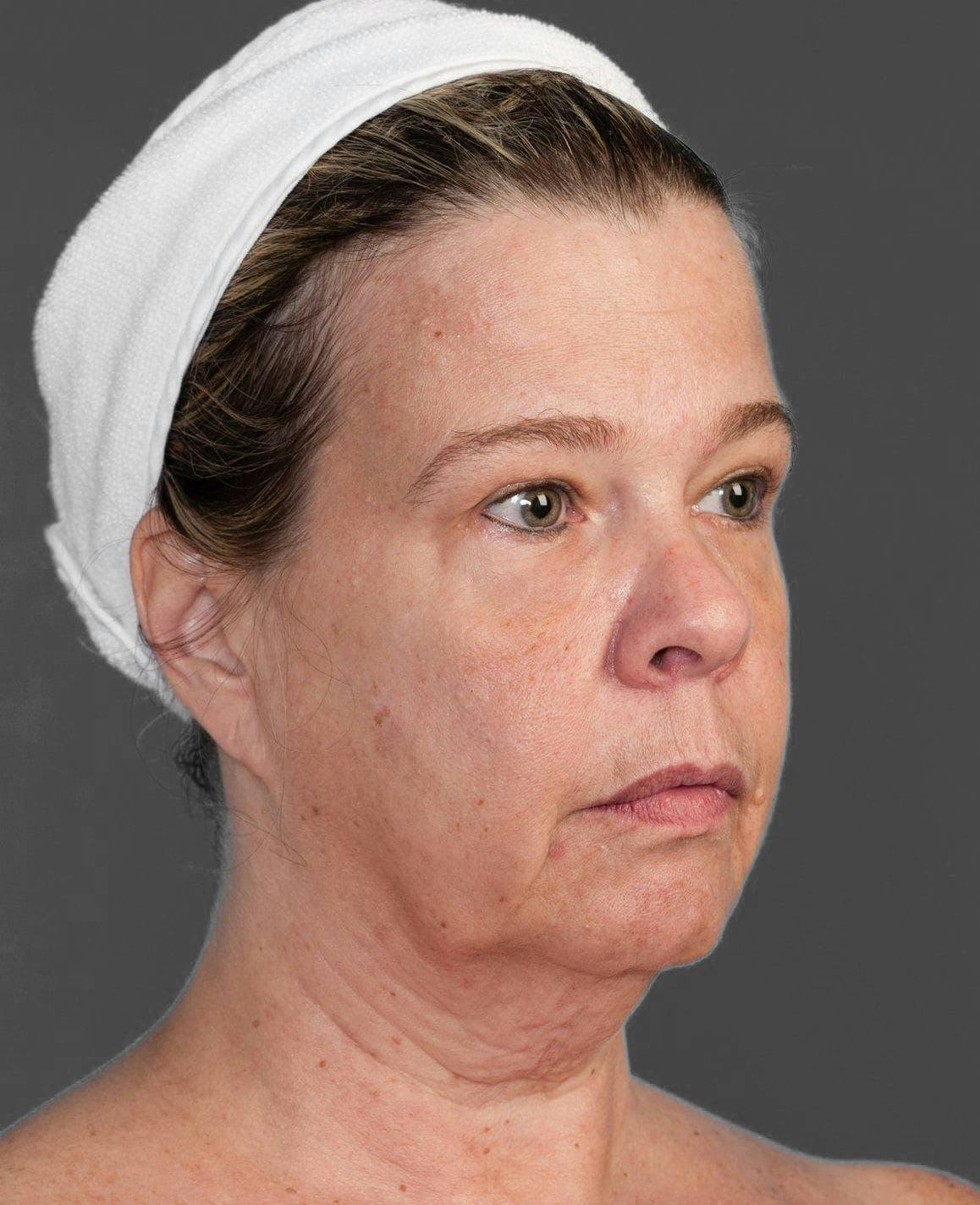 Facelift & Necklift before in NYC right profile view p#3