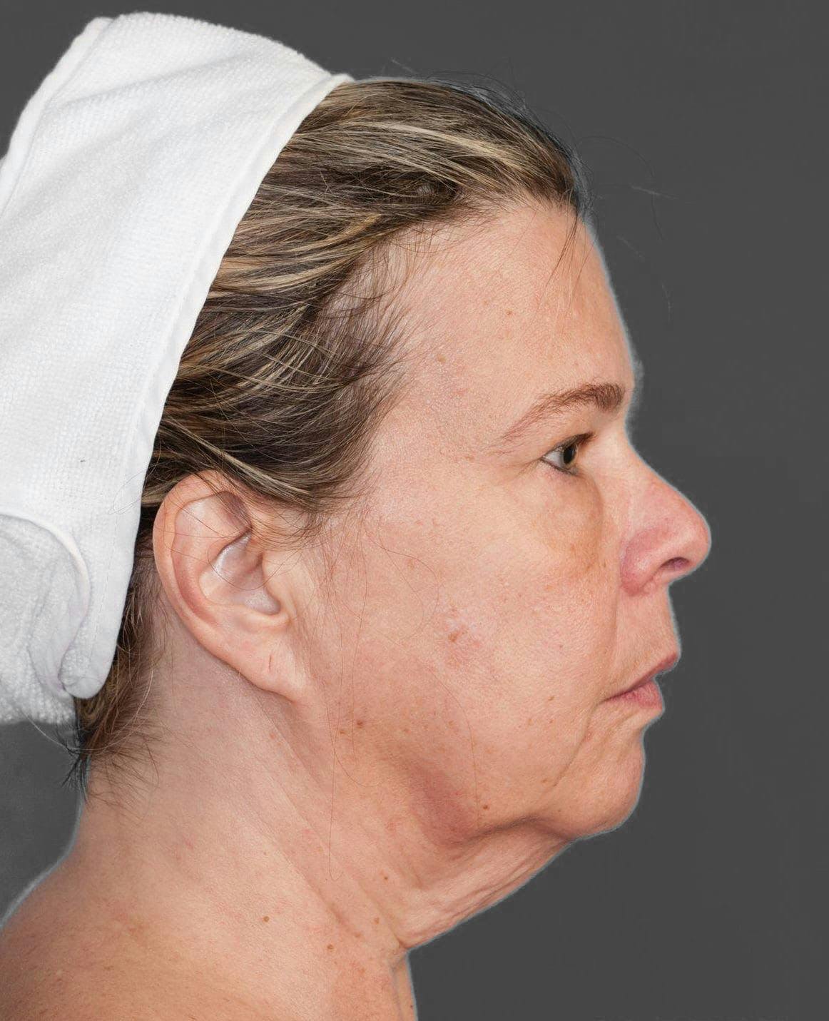 Facelift & Necklift before in NYC right side view p#3