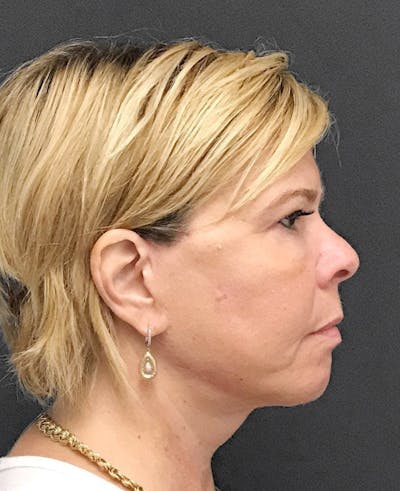 Facelift & Necklift after in NYC right side view p#3