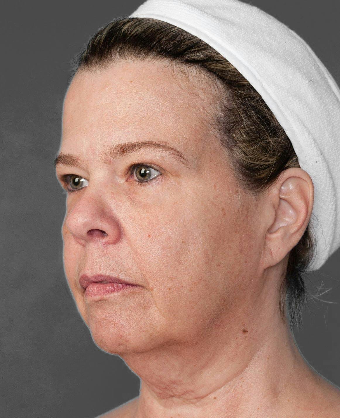 Facelift & Necklift before in NYC left profile view p#3