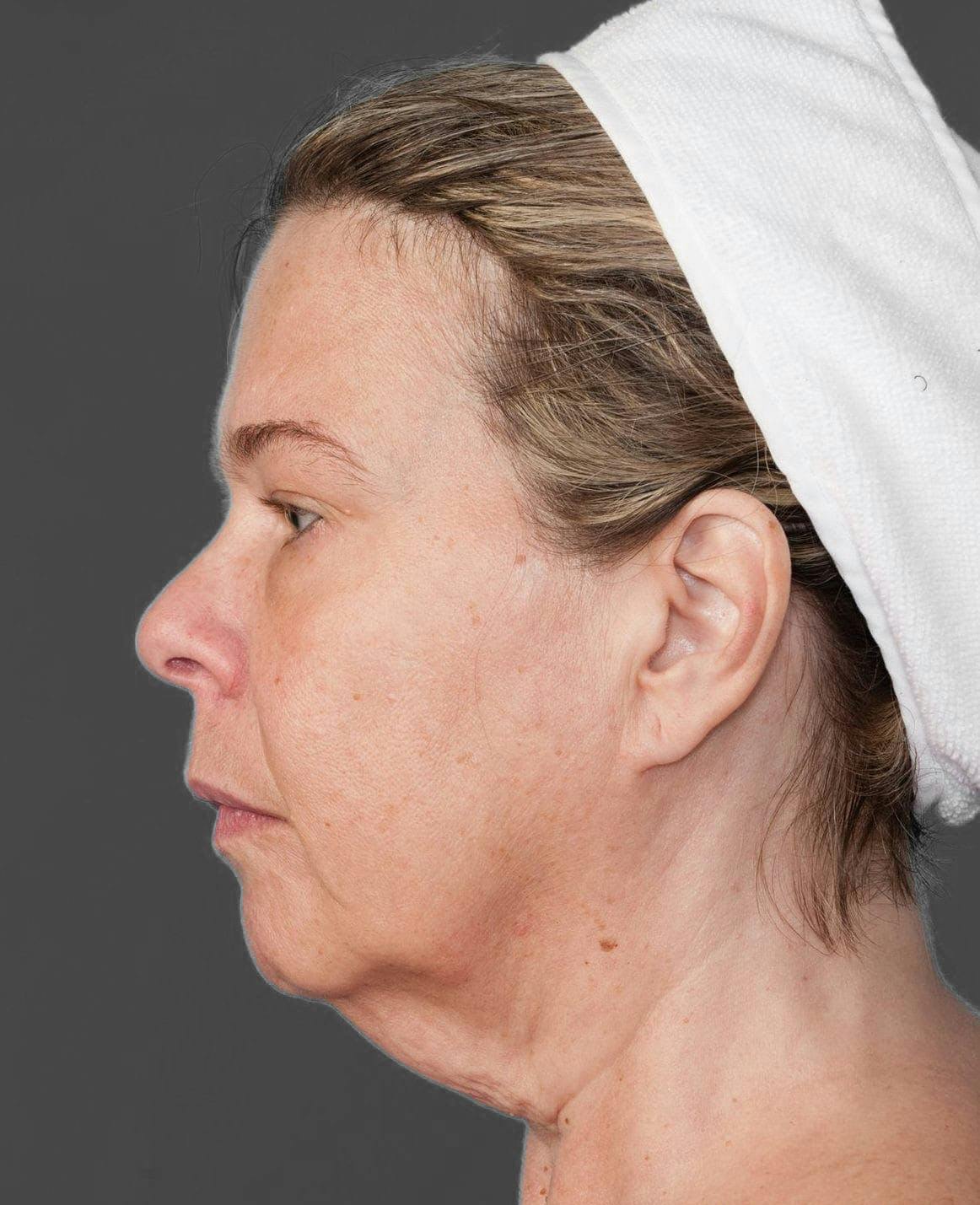 Facelift & Necklift before in NYC left side view p#3