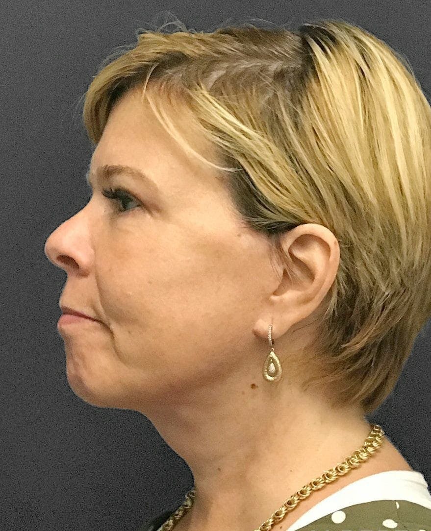 Facelift & Necklift after in NYC left side view p#3