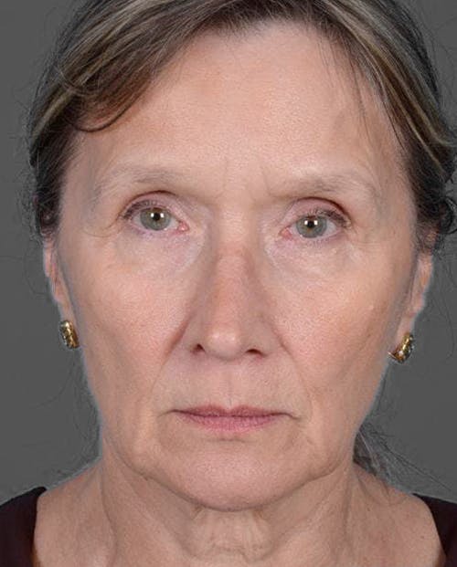 Facelift / Necklift Before & After Gallery - Patient 151452110 - Image 1
