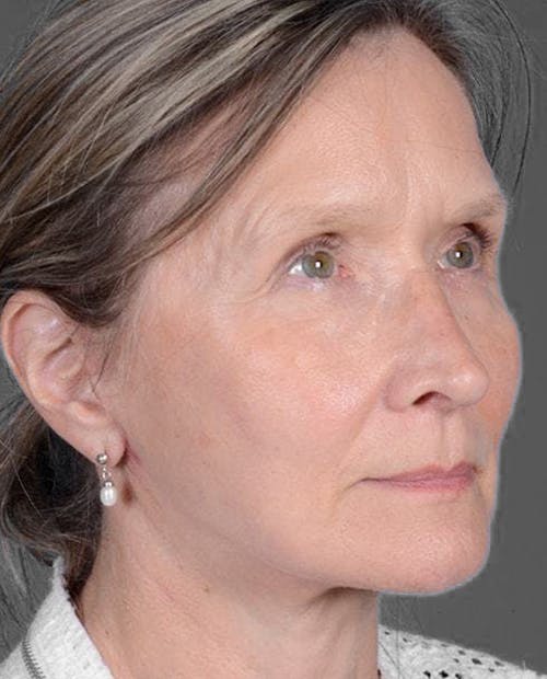 Facelift & Necklift after in NYC right profile view p#2