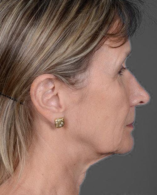 Facelift & Necklift before in NYC right side view p#2