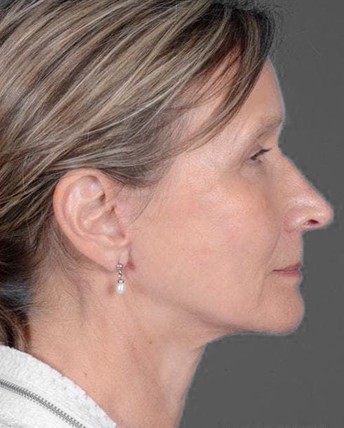 Facelift & Necklift after in NYC right side view p#2