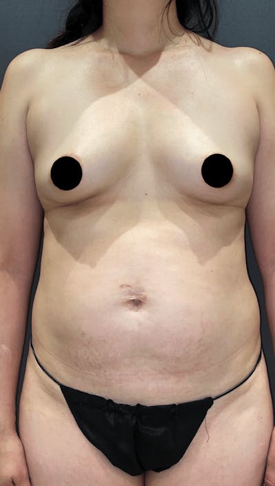 Breast Augmentation Before & After Gallery - Patient 151362512 - Image 1