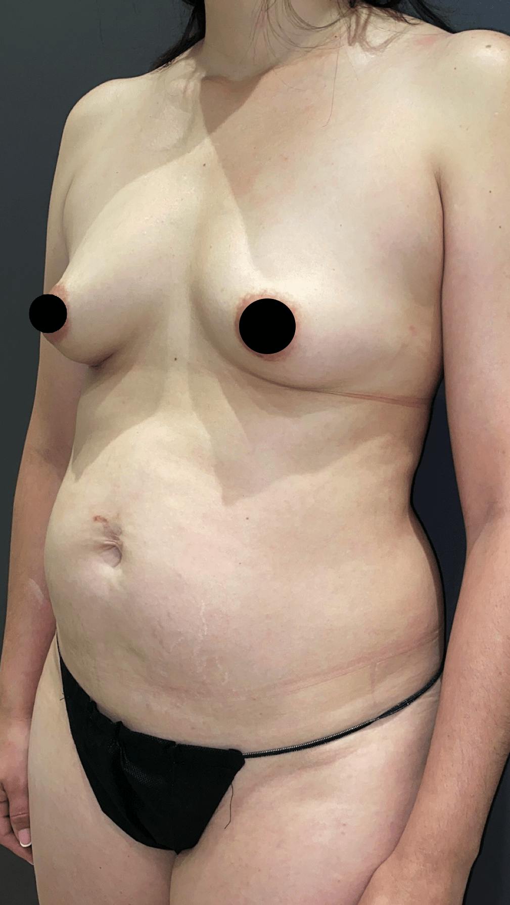 Breast Augmentation Before & After Gallery - Patient 151362512 - Image 3