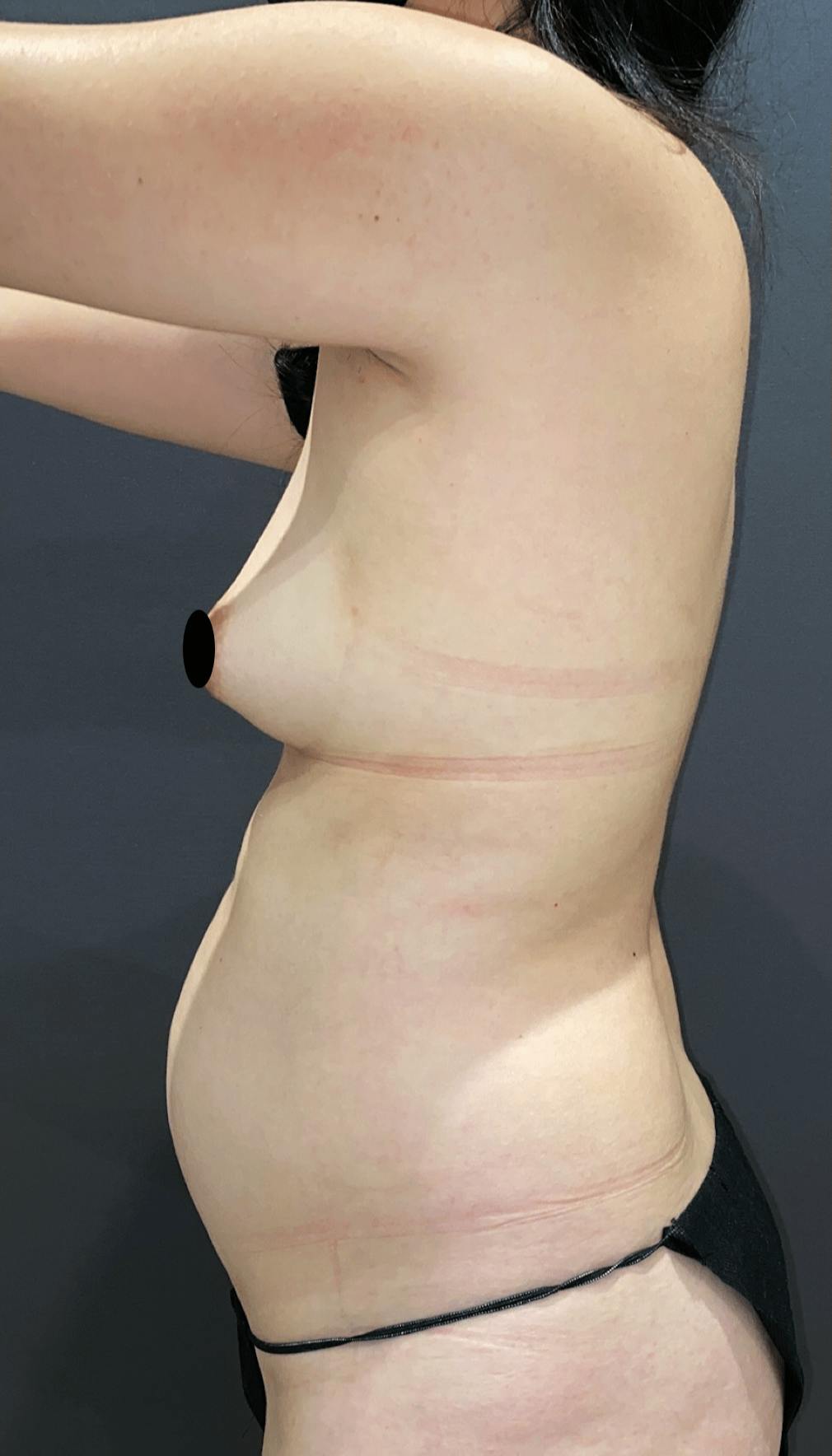 Breast Augmentation Before & After Gallery - Patient 151362512 - Image 5