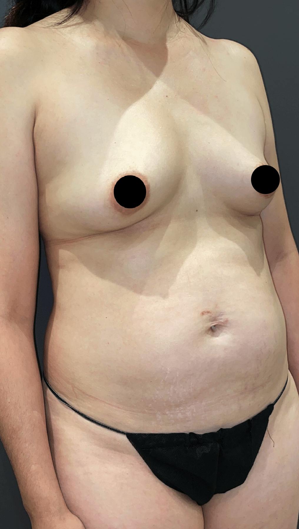 Breast Augmentation Before & After Gallery - Patient 151362512 - Image 7