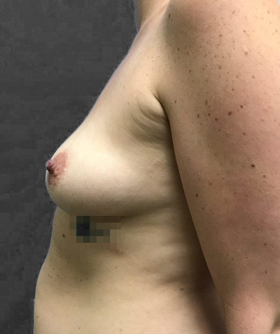 Breast Augmentation Before & After Gallery - Patient 151362525 - Image 5
