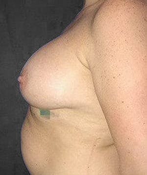 Breast Augmentation Before & After Gallery - Patient 151362525 - Image 6