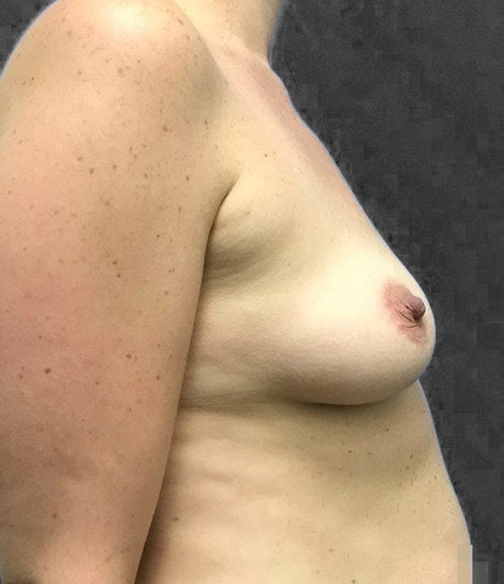 Breast Augmentation Before & After Gallery - Patient 151362525 - Image 9