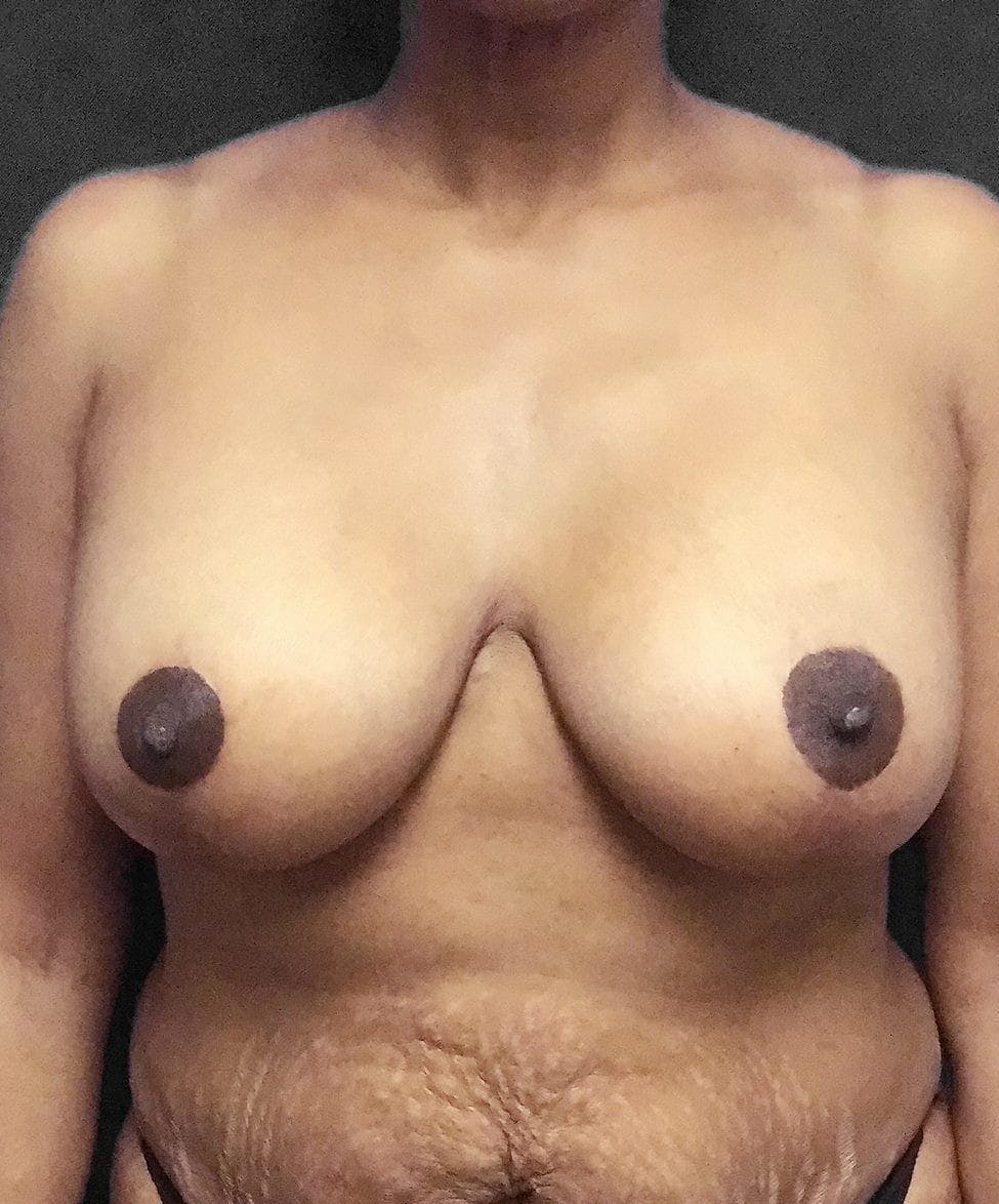 Breast Augmentation Before & After Gallery - Patient 151362511 - Image 2