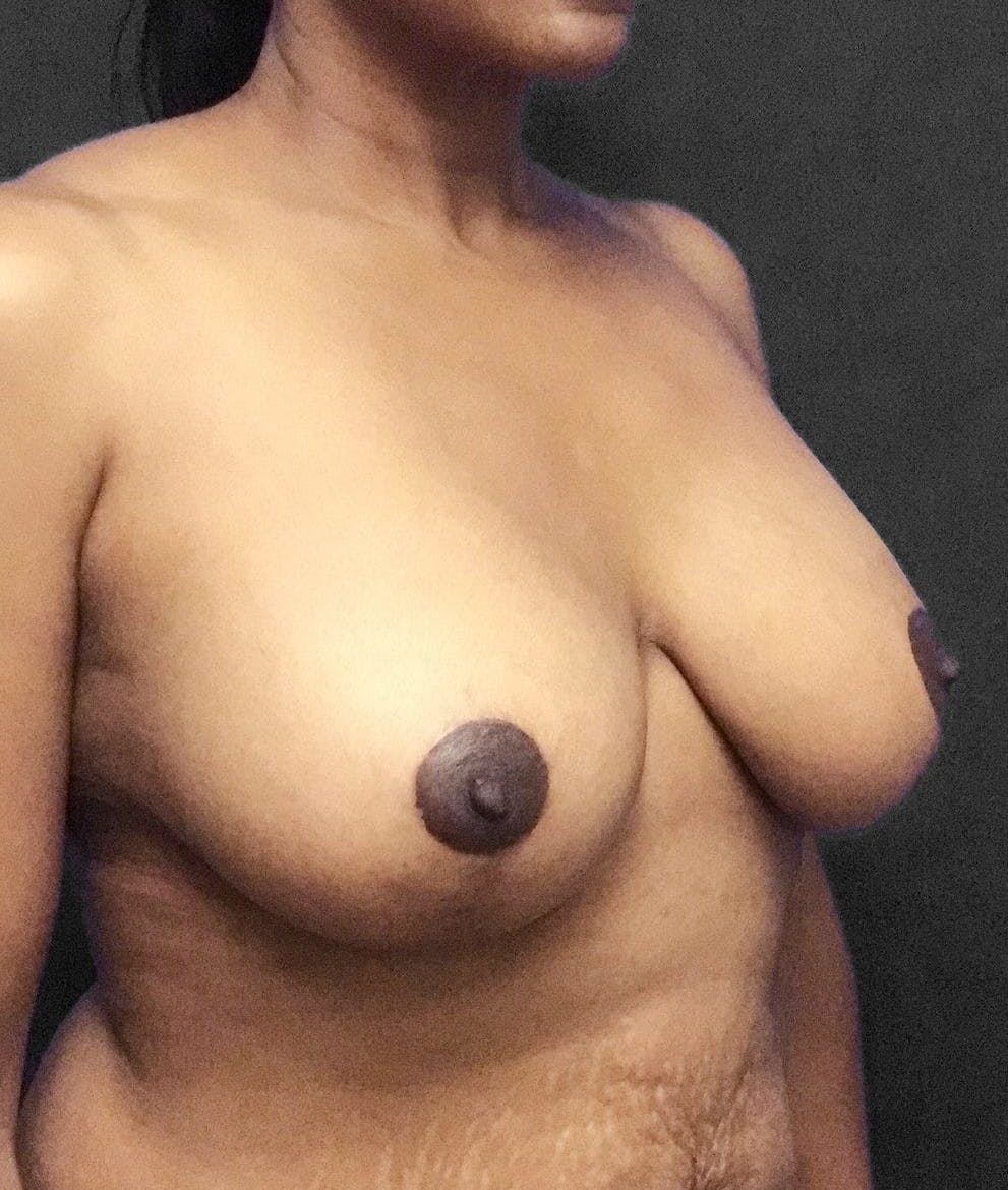 Breast Augmentation Before & After Gallery - Patient 151362511 - Image 4