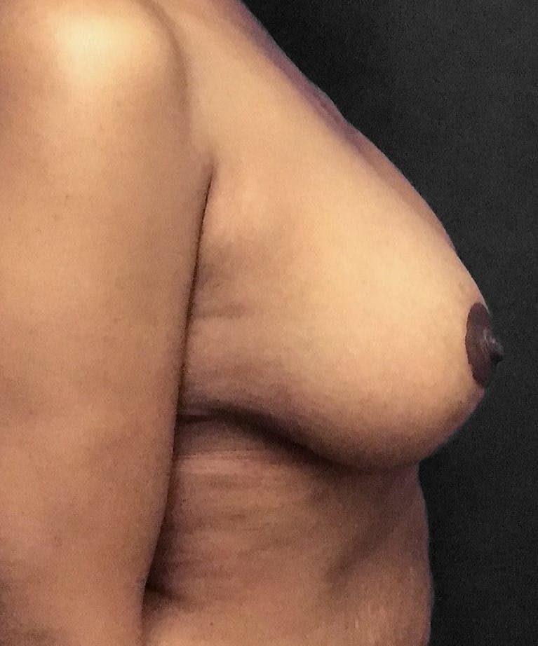 Breast Augmentation Before & After Gallery - Patient 151362511 - Image 6