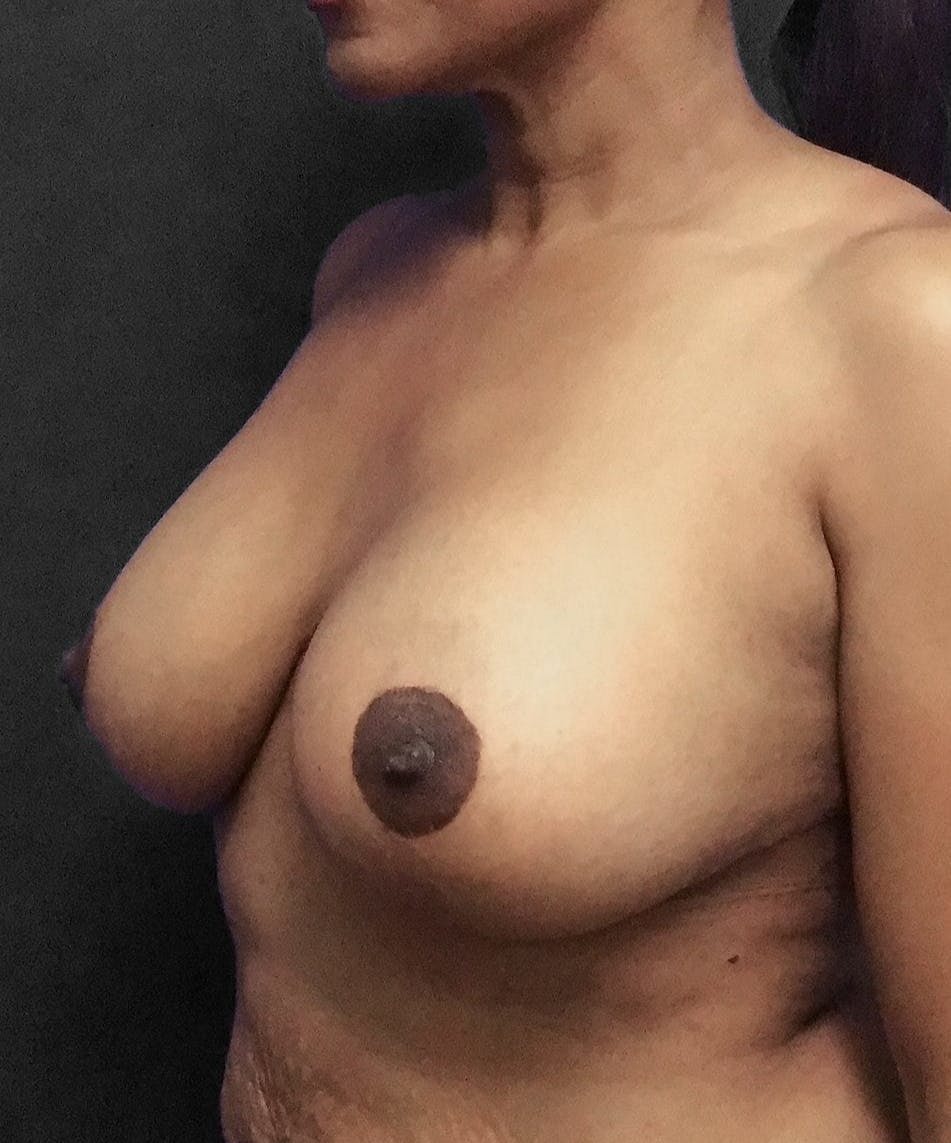 Breast Augmentation Before & After Gallery - Patient 151362511 - Image 8