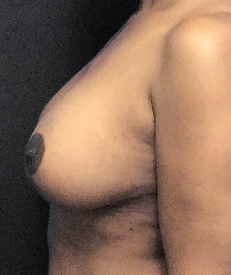 Breast Augmentation Before & After Gallery - Patient 151362511 - Image 10