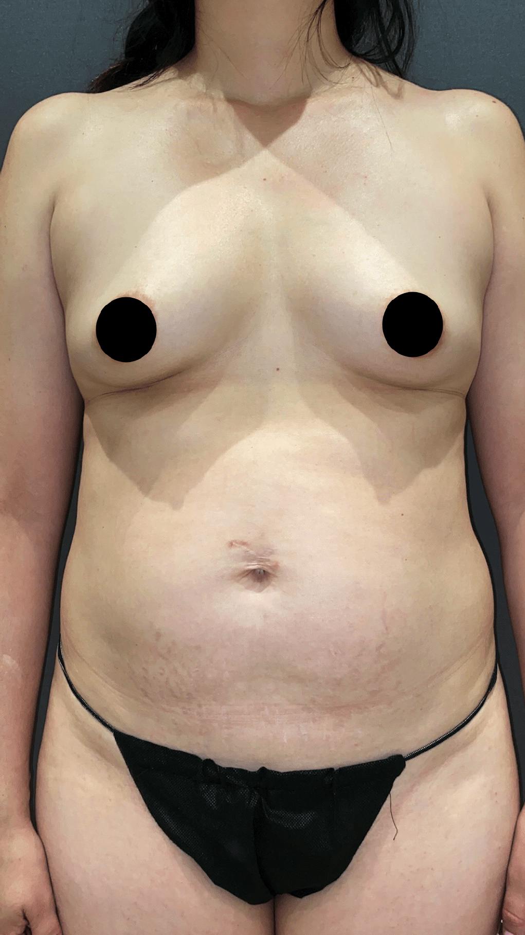 Liposuction Before & After Gallery - Patient 151452153 - Image 1