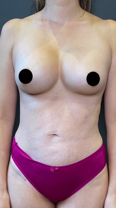 Liposuction Before & After Gallery - Patient 151452153 - Image 2