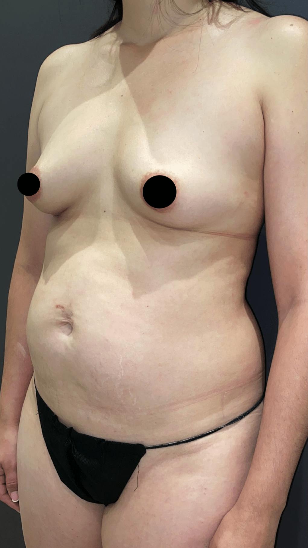 Liposuction Before & After Gallery - Patient 151452153 - Image 3