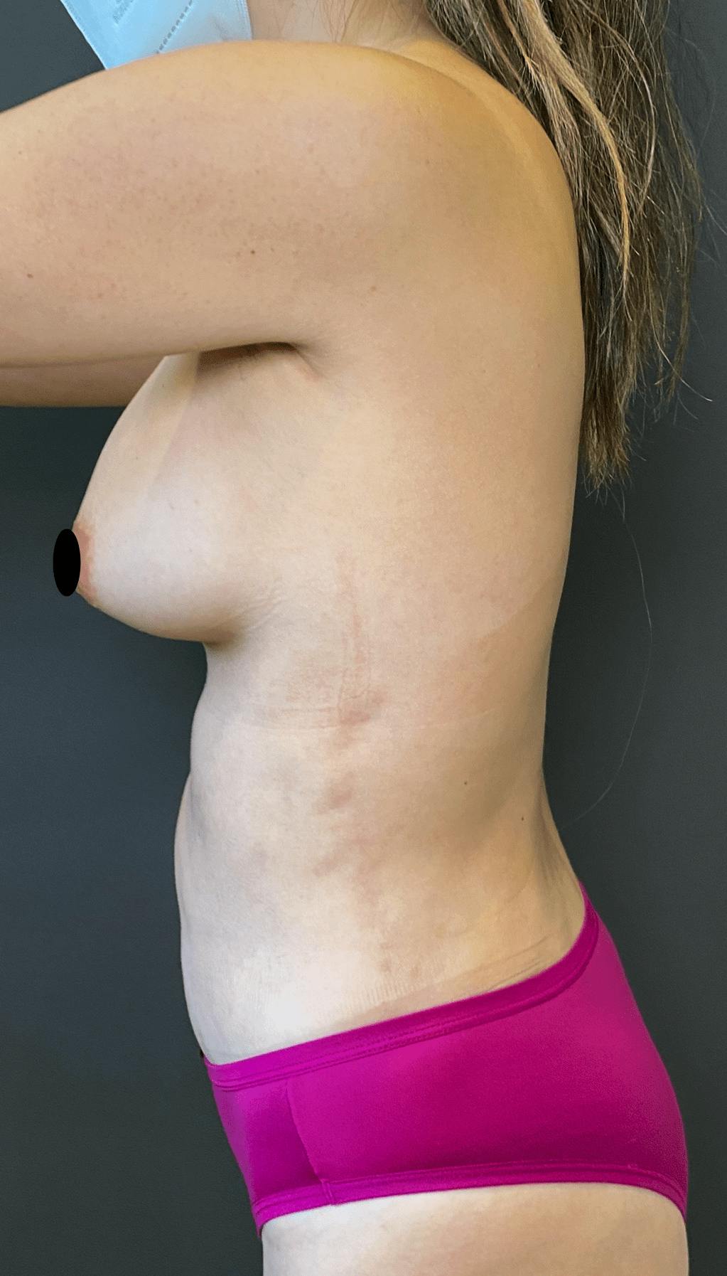 Liposuction Before & After Gallery - Patient 151452153 - Image 6