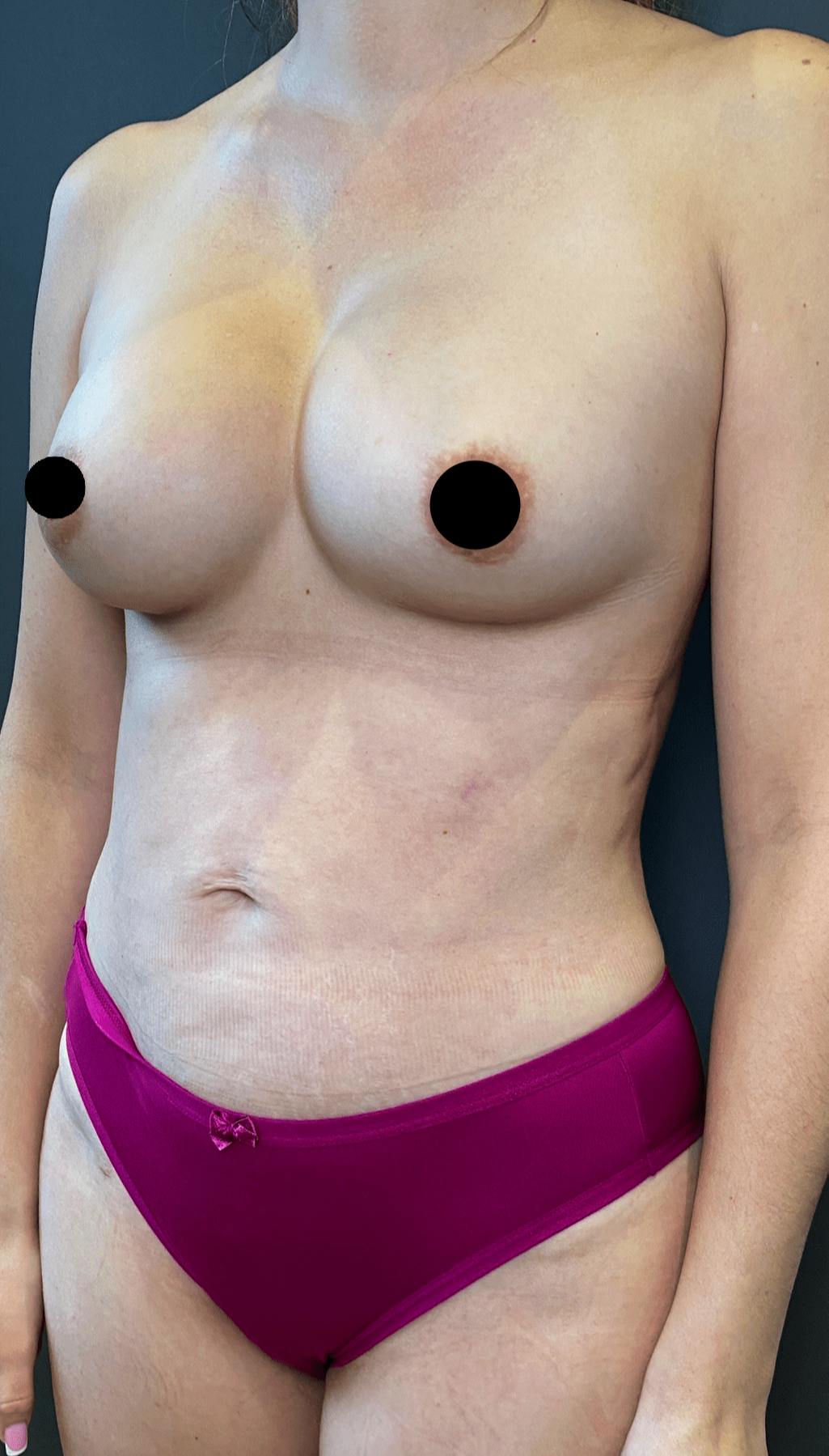 Liposuction Before & After Gallery - Patient 151452153 - Image 4