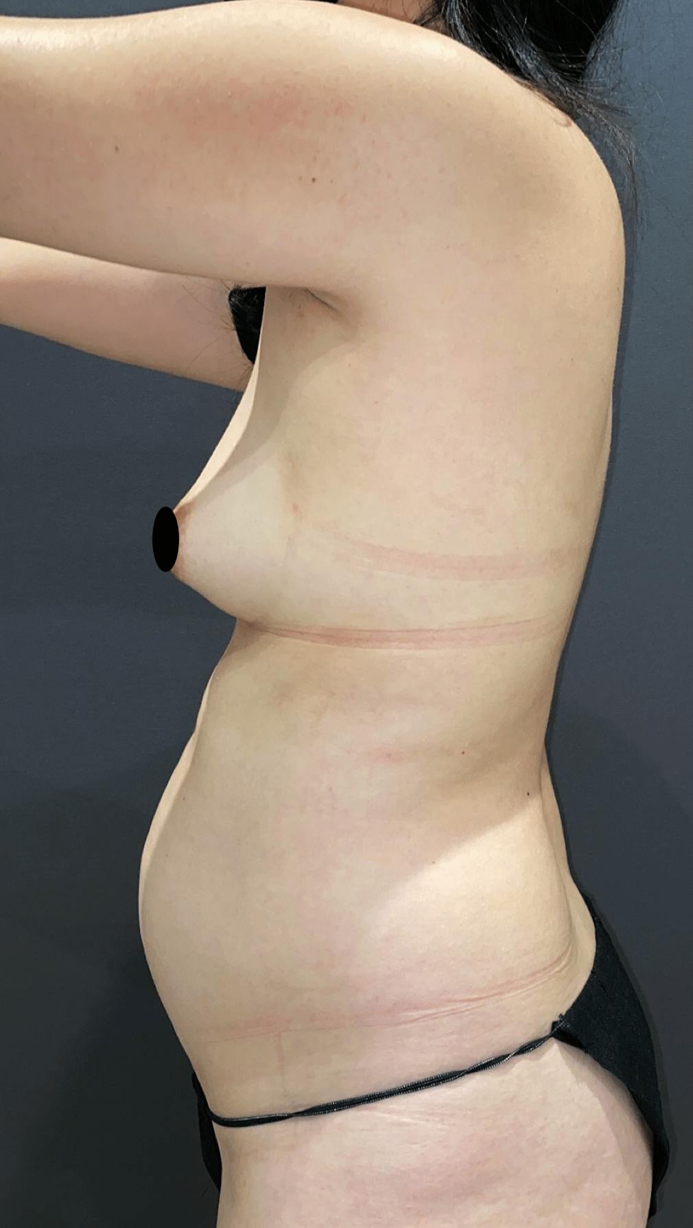 Liposuction Before & After Gallery - Patient 151452153 - Image 5