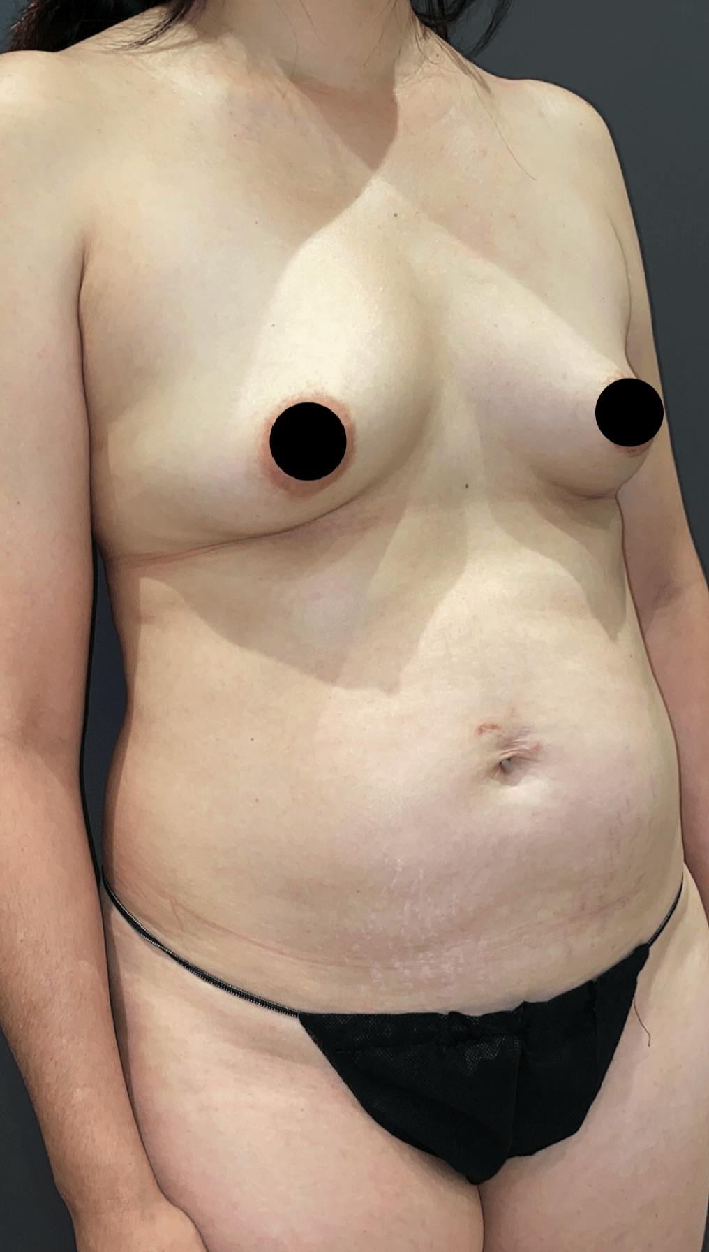 Liposuction Before & After Gallery - Patient 151452153 - Image 7