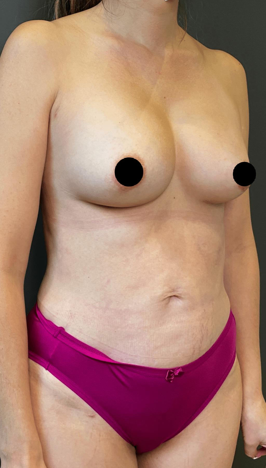 Liposuction Before & After Gallery - Patient 151452153 - Image 8
