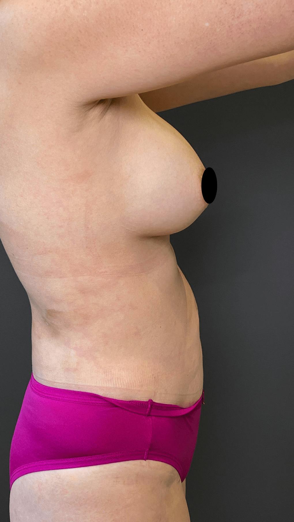 Liposuction Before & After Gallery - Patient 151452153 - Image 9