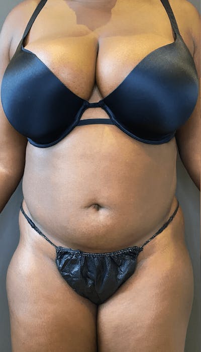 Liposuction Before & After Gallery - Patient 151452147 - Image 1