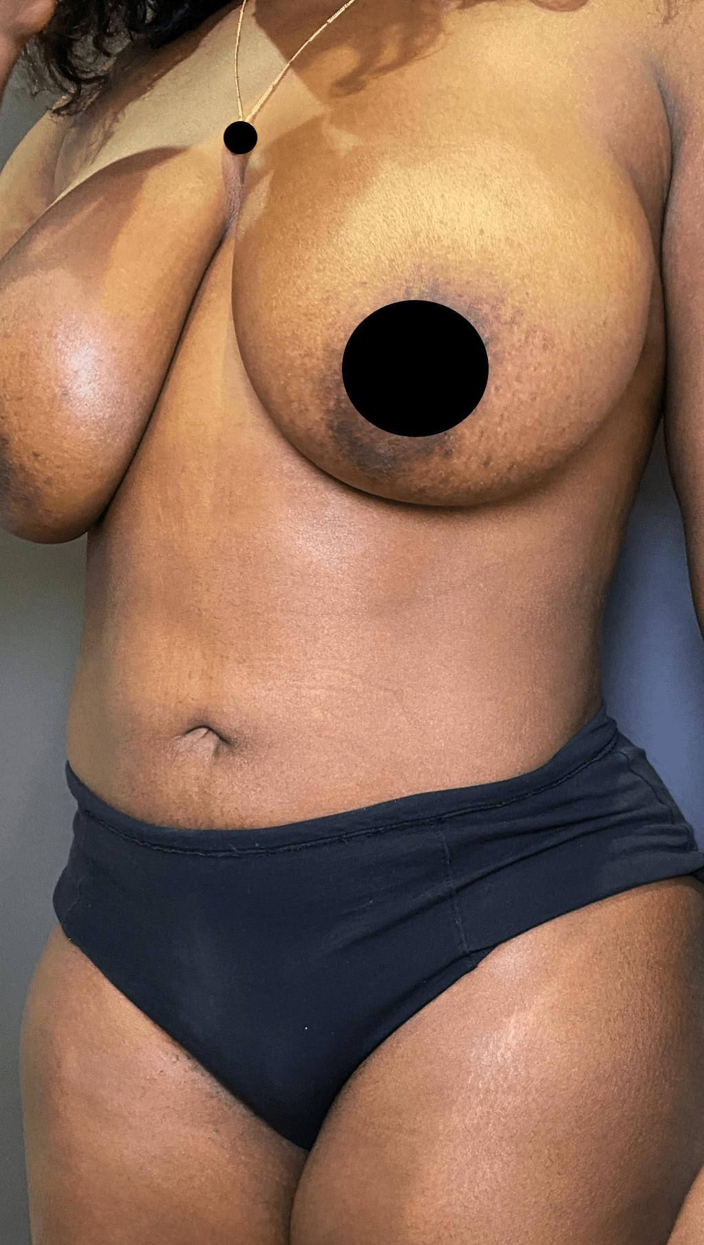 Liposuction Before & After Gallery - Patient 151452147 - Image 4