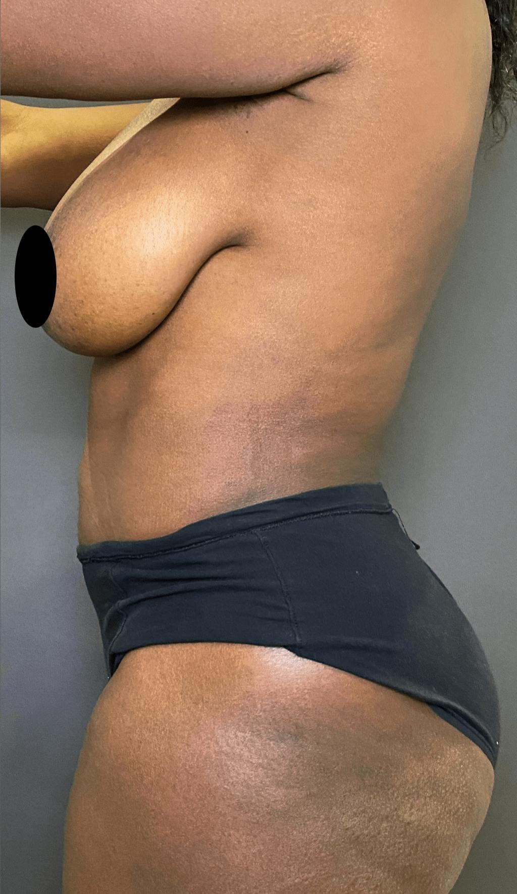 Liposuction Before & After Gallery - Patient 151452147 - Image 6