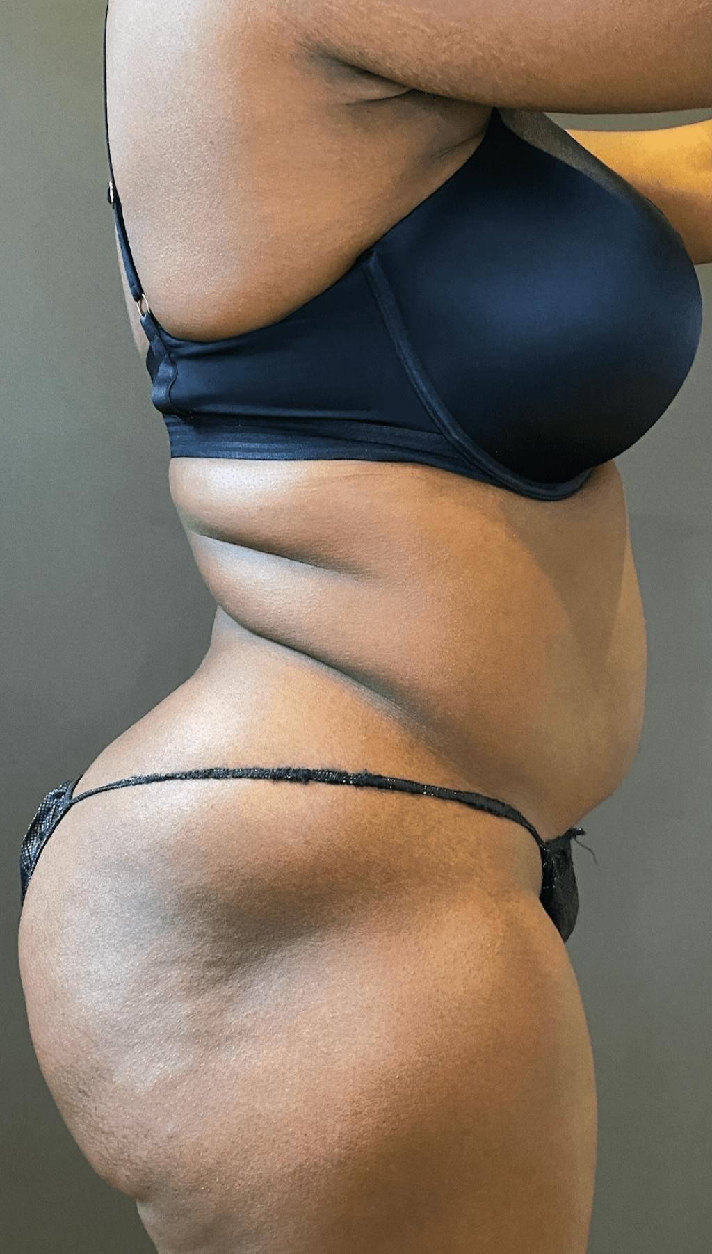 Liposuction Before & After Gallery - Patient 151452147 - Image 7