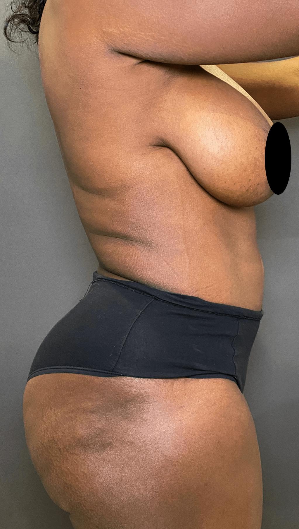 Liposuction Before & After Gallery - Patient 151452147 - Image 8