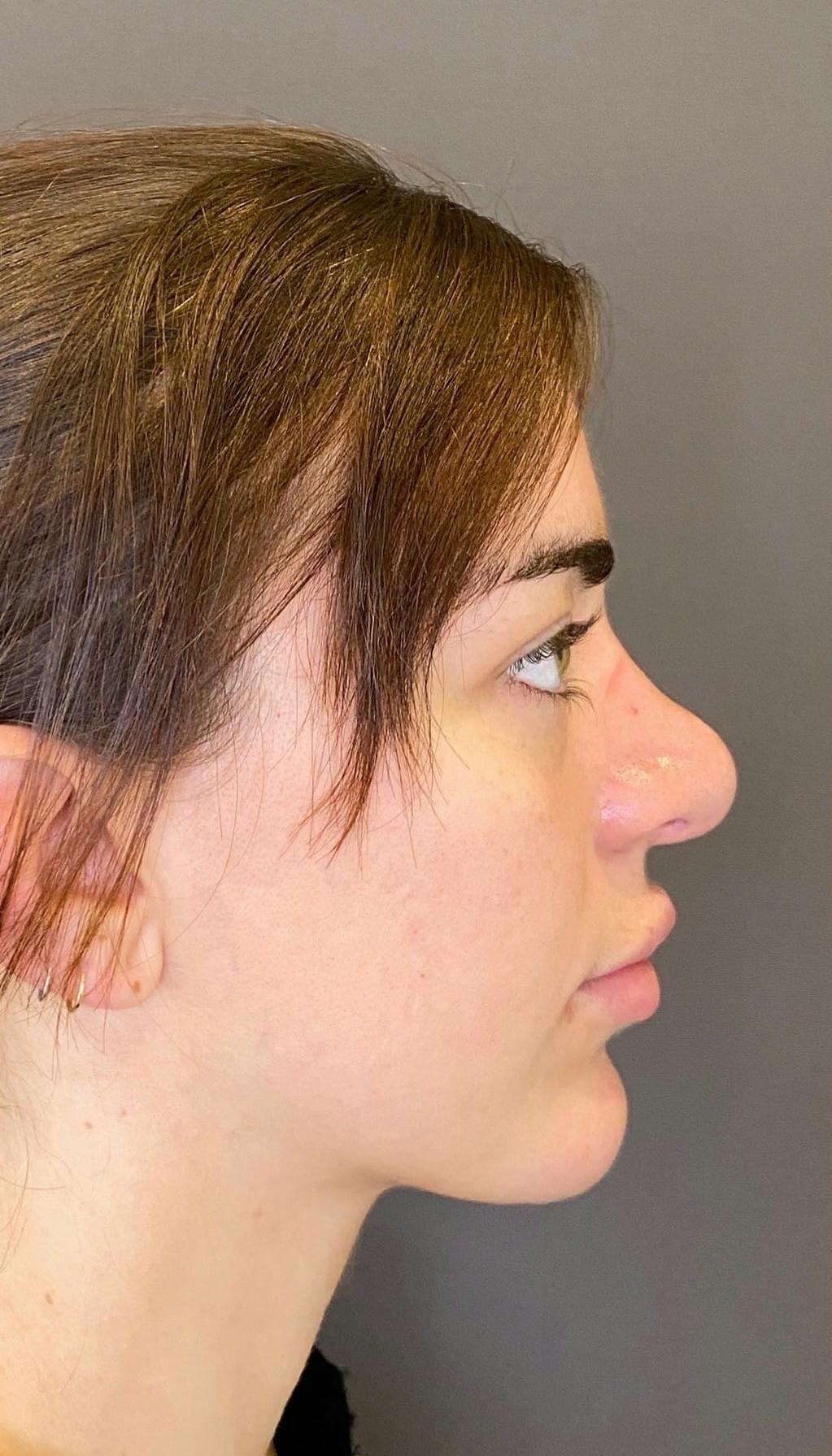 Revision Rhinoplasty Before & After Gallery - Patient 151452168 - Image 1