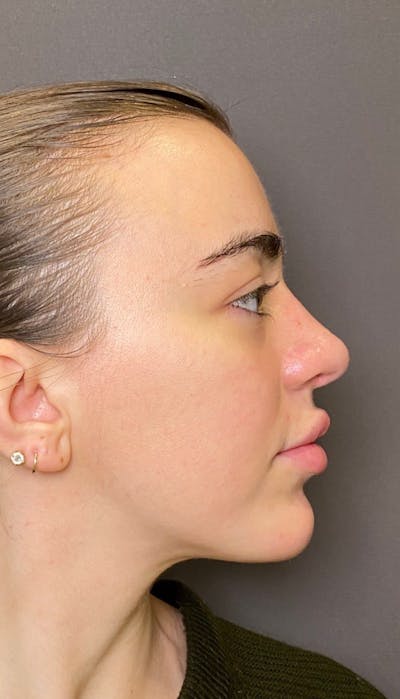 Revision Rhinoplasty Before & After Gallery - Patient 151452168 - Image 2