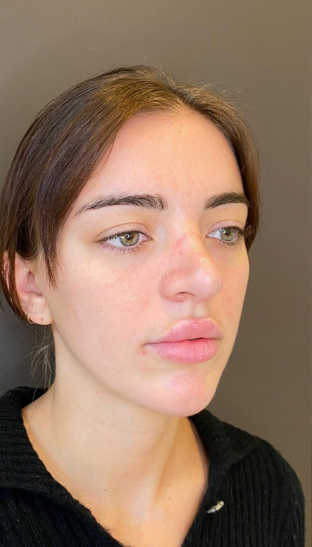 Revision Rhinoplasty Before & After Gallery - Patient 151452168 - Image 3