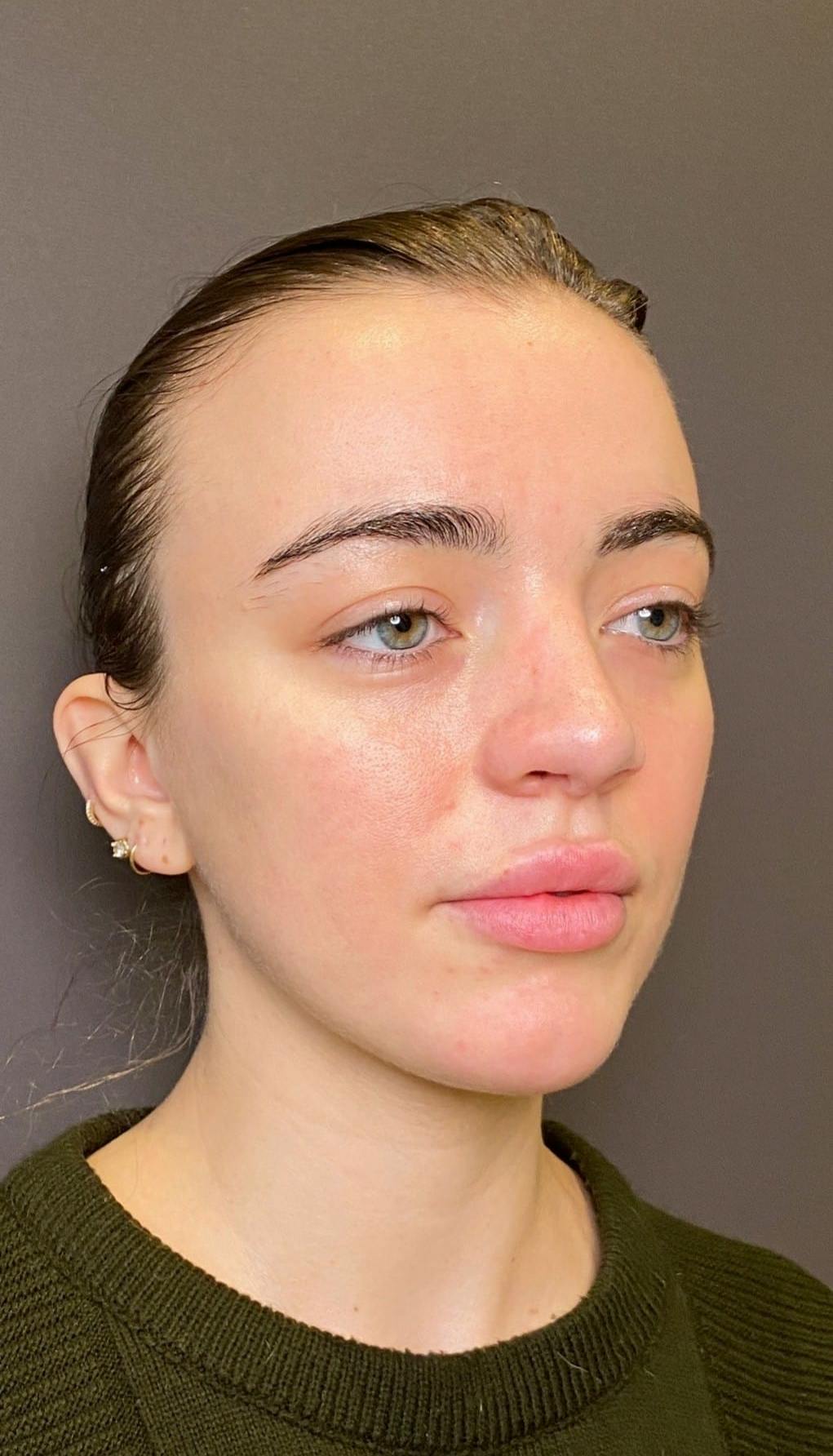 Revision Rhinoplasty Before & After Gallery - Patient 151452168 - Image 4
