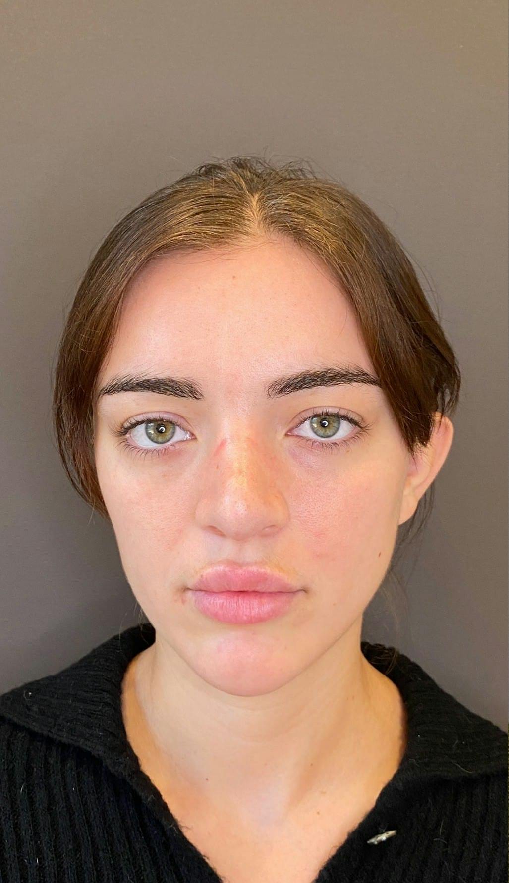 Revision Rhinoplasty Before & After Gallery - Patient 151452168 - Image 5