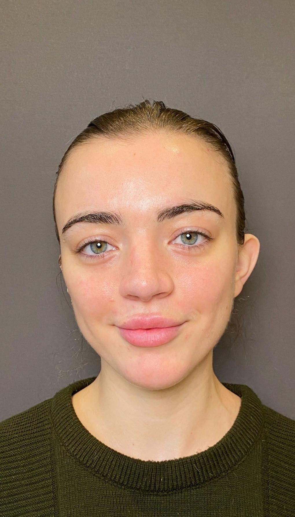 Revision Rhinoplasty Before & After Gallery - Patient 151452168 - Image 6