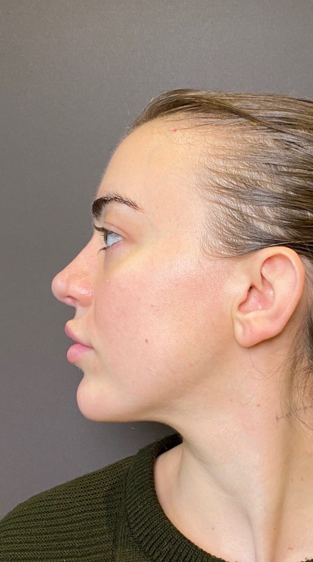 Revision Rhinoplasty Before & After Gallery - Patient 151452168 - Image 8