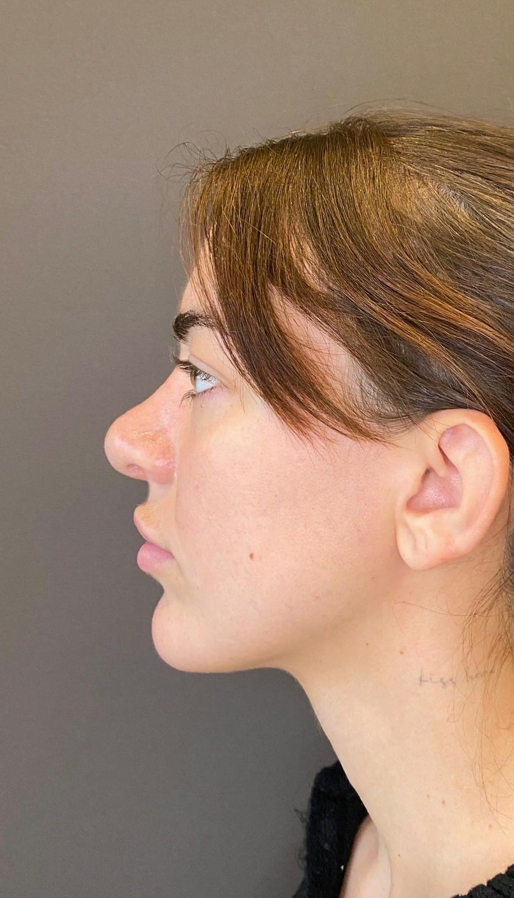 Revision Rhinoplasty Before & After Gallery - Patient 151452168 - Image 7