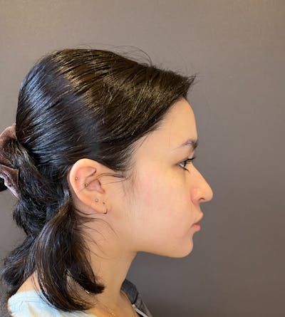 Rhinoplasty Before & After Gallery - Patient 151510779 - Image 1