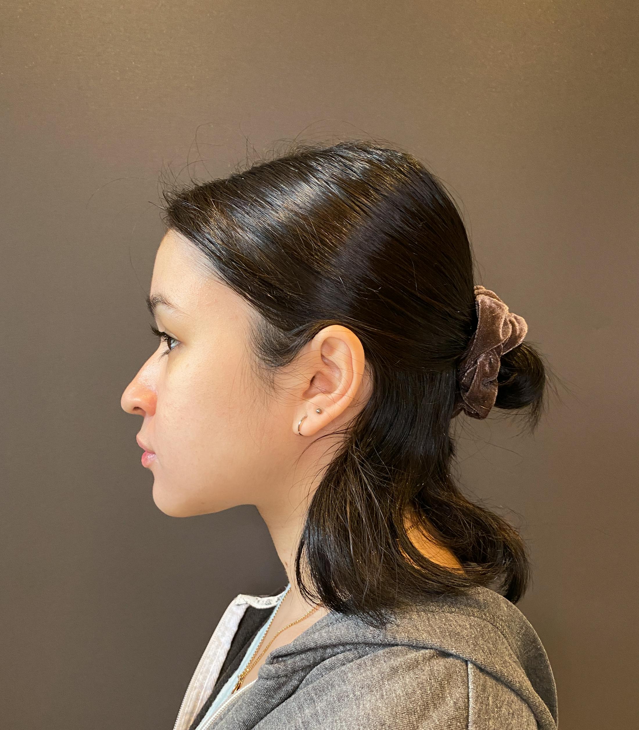 Rhinoplasty Before & After Gallery - Patient 151510779 - Image 9