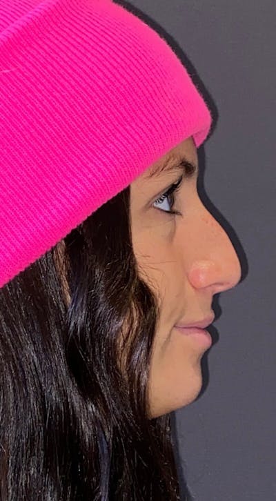 Rhinoplasty Before & After Gallery - Patient 151510791 - Image 1