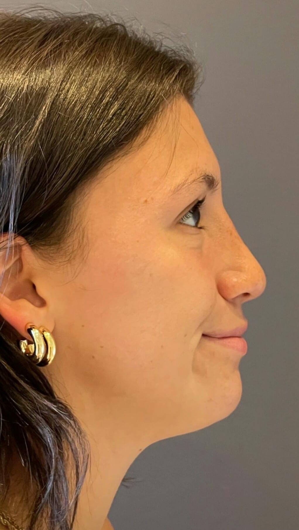 Rhinoplasty Before & After Gallery - Patient 151510791 - Image 2