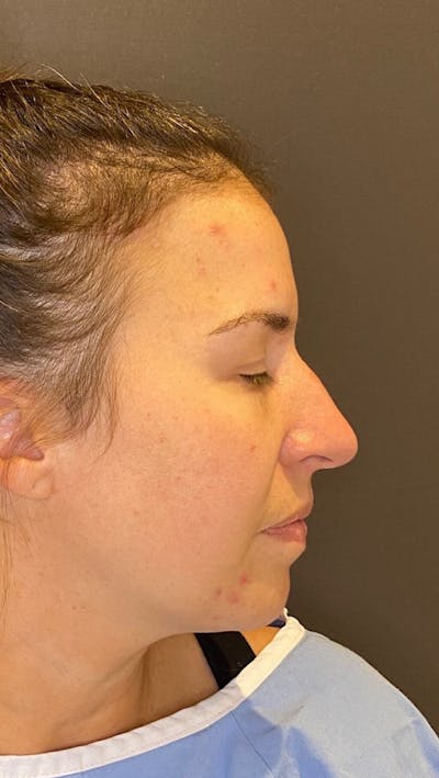 Rhinoplasty Before & After Gallery - Patient 151510790 - Image 1
