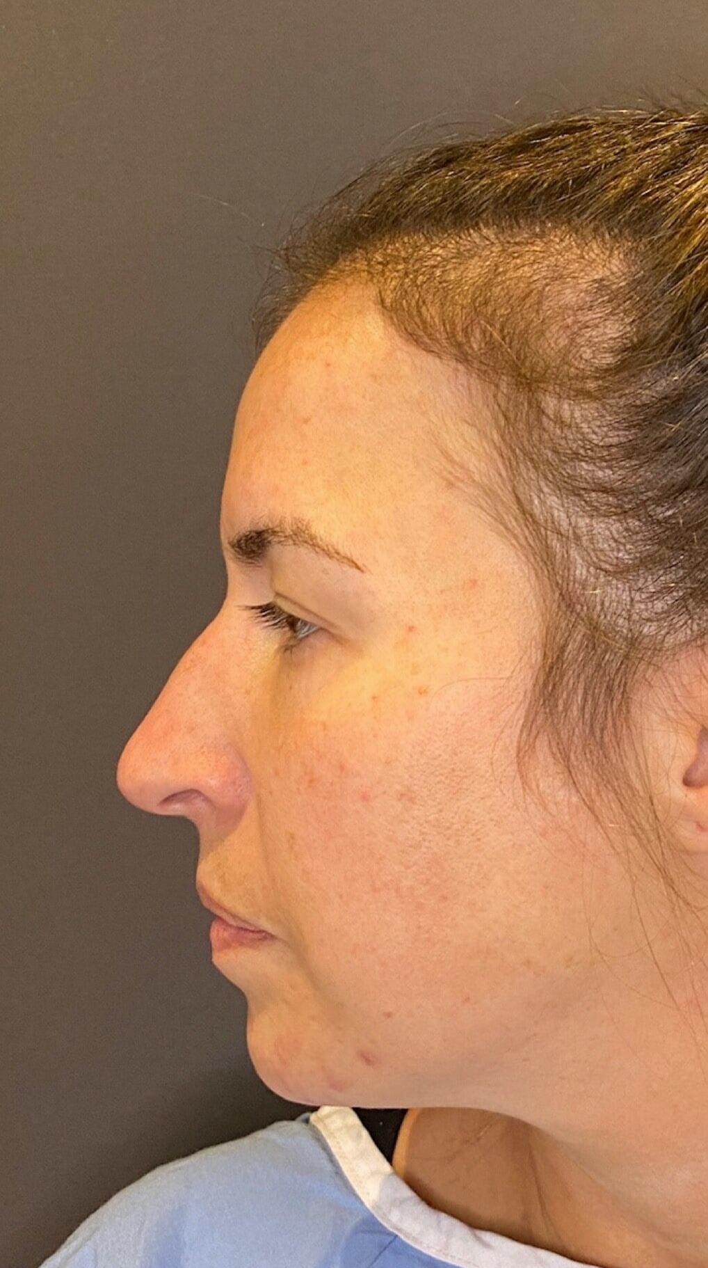 Rhinoplasty Before & After Gallery - Patient 151510790 - Image 7